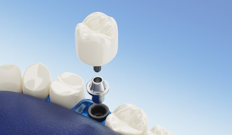 close up component dental implant transparent 3d rendering